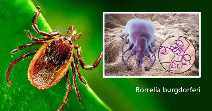 BORELIÓZA – stále viac rozšírená nepríjemná infekcia